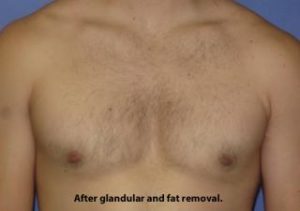 Gynecomastia Before & After Patient #1359