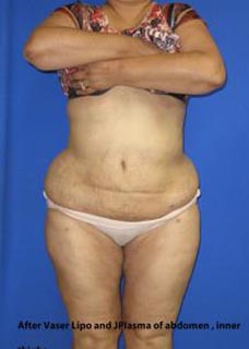 VASER Liposuction Before & After Patient #7256