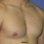 Gynecomastia Before & After Patient #1359