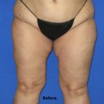 VASER Liposuction Before & After Patient #7256