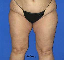 VASER Liposuction Before & After Patient #7256