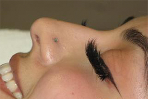 Non-Surgical Rhinoplasty Before & After Patient #805