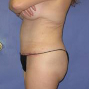 Avelar Tummy Tuck Before & After Patient #144