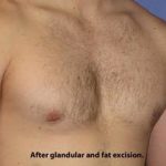 Gynecomastia Before & After Patient #1359