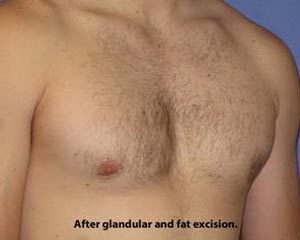 Gynecomastia Before & After Patient #1359