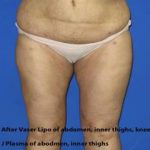 VASER Liposuction Before & After Patient #7256