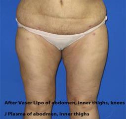 VASER Liposuction Before & After Patient #7256