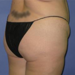 Brazilian Butt Lift Before & After Patient #7345