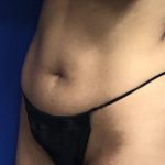 VASER Liposuction Hi-Def Before & After Patient #7266