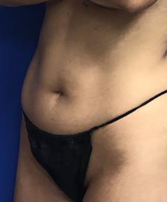 VASER Liposuction Hi-Def Before & After Patient #7266