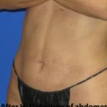 VASER Liposuction Hi-Def Before & After Patient #7266