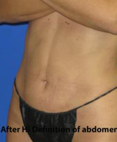 VASER Liposuction Hi-Def Before & After Patient #7266