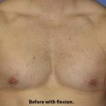 Gynecomastia Before & After Patient #1359