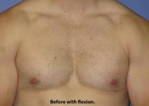 Gynecomastia Before & After Patient #1359