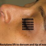 Non-Surgical Rhinoplasty Before & After Patient #798