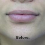 Lips Before & After Patient #755