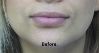 Lips Before & After Patient #755