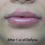 Lips Before & After Patient #755