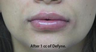 Lips Before & After Patient #755