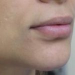 Lips Before & After Patient #755