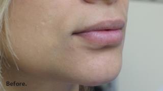 Lips Before & After Patient #755