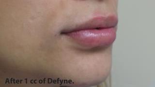 Lips Before & After Patient #755