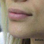 Lips Before & After Patient #755