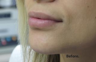 Lips Before & After Patient #755