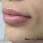 Lips Before & After Patient #755