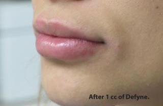 Lips Before & After Patient #755