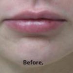 Lips Before & After Patient #748