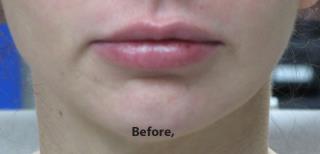 Lips Before & After Patient #748