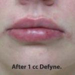 Lips Before & After Patient #748