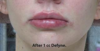 Lips Before & After Patient #748