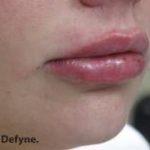 Lips Before & After Patient #748