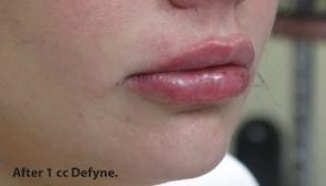 Lips Before & After Patient #748