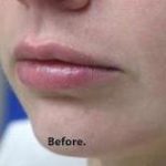 Lips Before & After Patient #748