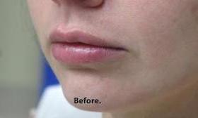 Lips Before & After Patient #748