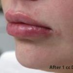 Lips Before & After Patient #748