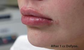 Lips Before & After Patient #748