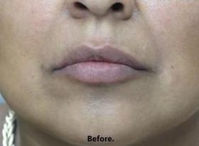 Lips Before & After Patient #738