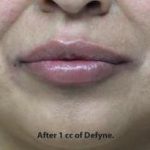 Lips Before & After Patient #738