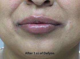 Lips Before & After Patient #738