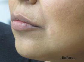Lips Before & After Patient #738