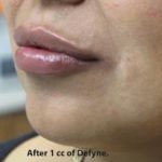 Lips Before & After Patient #738