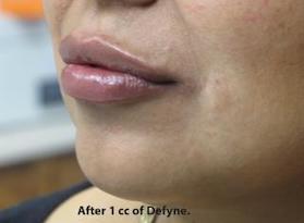 Lips Before & After Patient #738