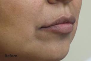 Lips Before & After Patient #738