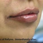 Lips Before & After Patient #738