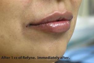 Lips Before & After Patient #738