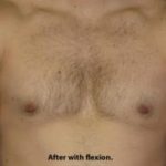 Gynecomastia Before & After Patient #1359